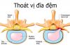 thoát vị đĩa đệm là bệnh gì thoát vị đĩa đệm là bệnh gì